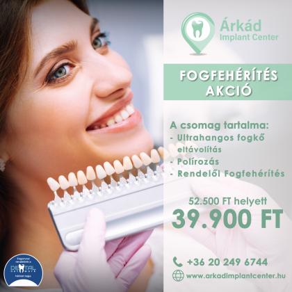 Fogfehérítés AKCIÓ