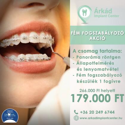 Fém Fogszabályozó Akció